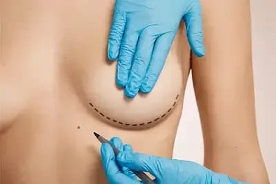 Chirurgie mammaire en Tunisie : augmentation, lifting, réduction